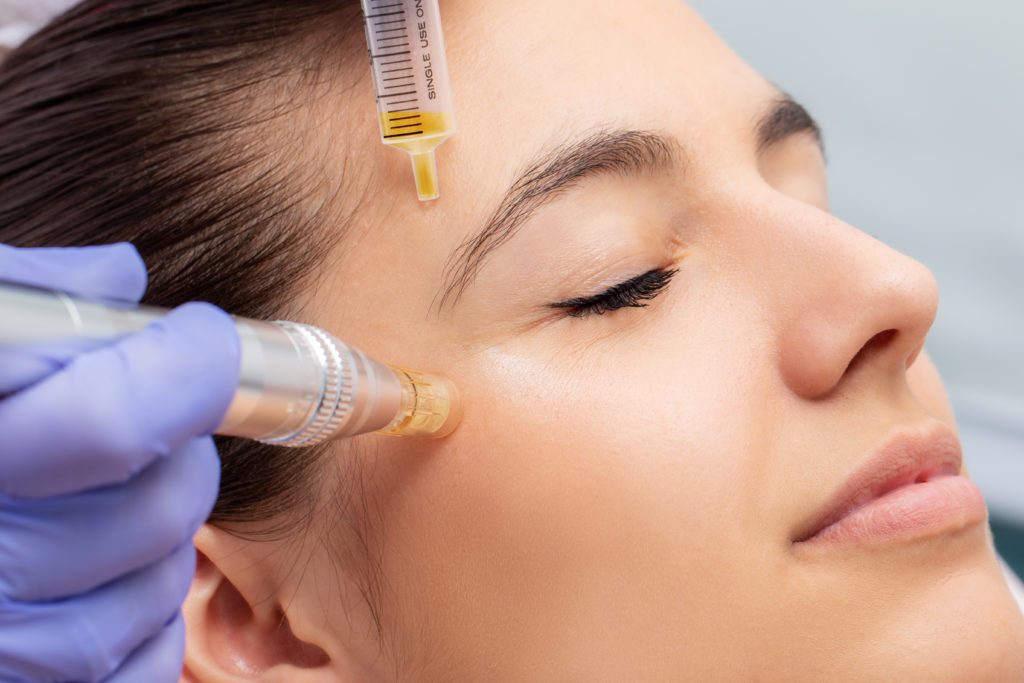RF microneedling treatment at Jeune Medspa La Habra