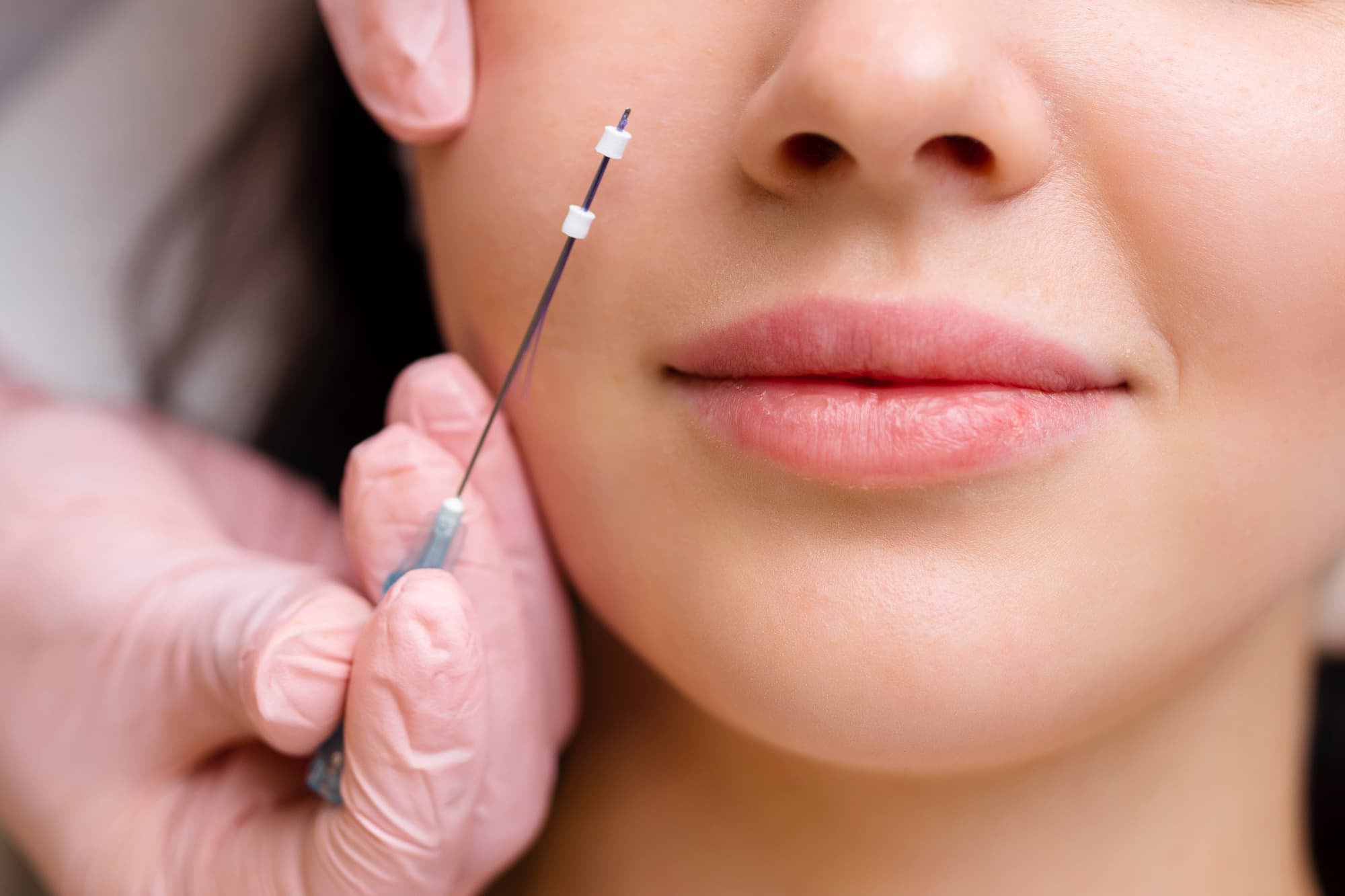 Thread lifting procedure at Jeune Medspa La Habra